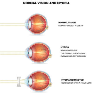 Myopia Control - Yukon Eyecare